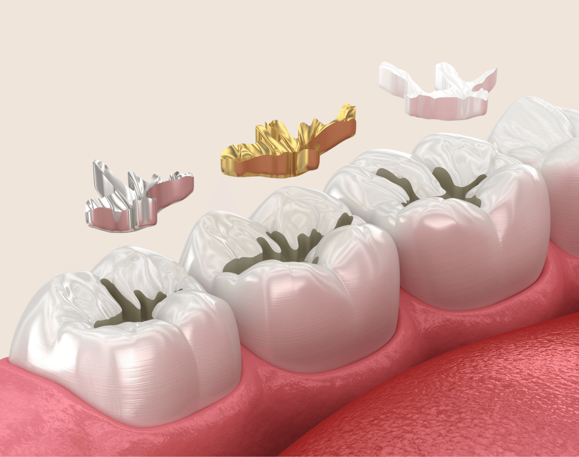 Illustration of molars with different filling materials