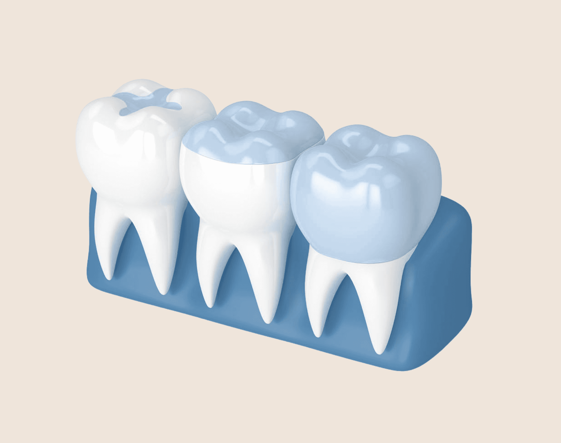 Illustration of molars with an inlay and an onlay