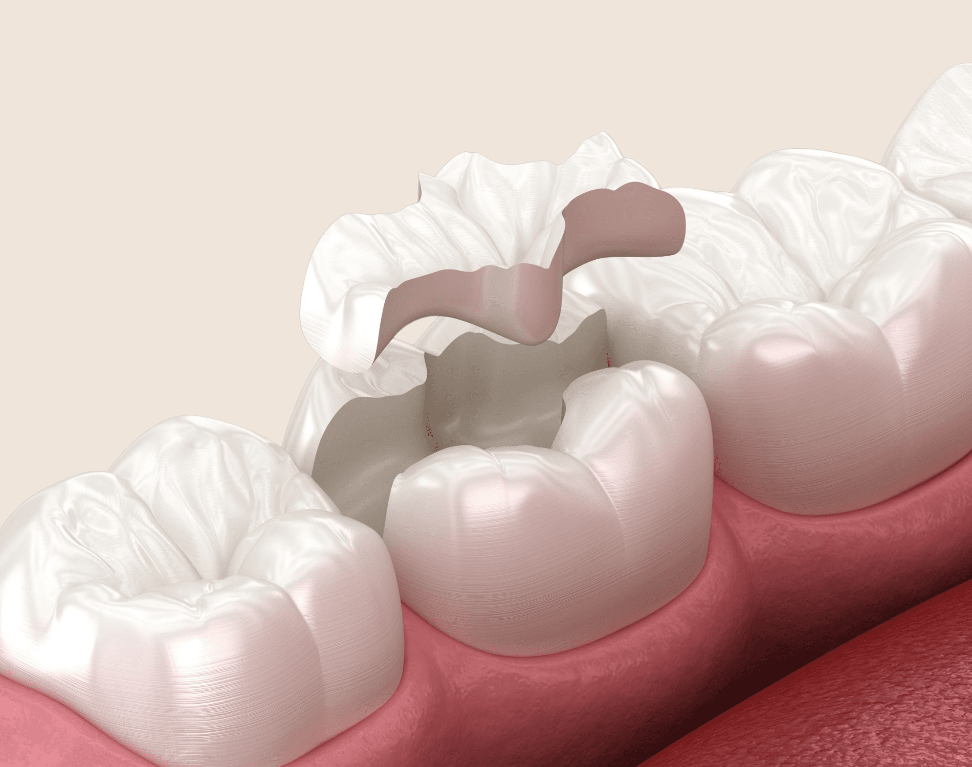 Illustration of a molar with a broken filling