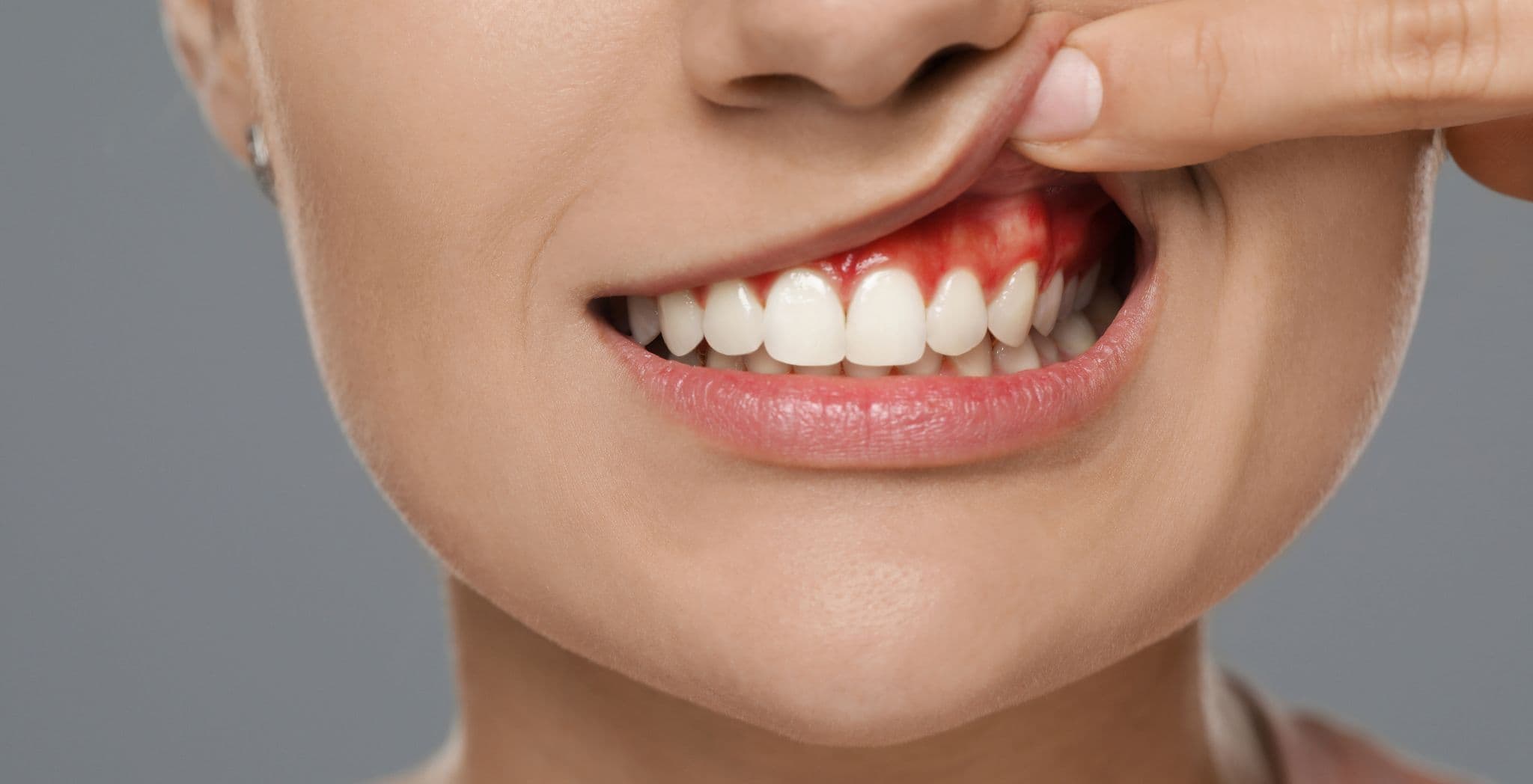 Woman lifting her lip to show a swollen, red gum