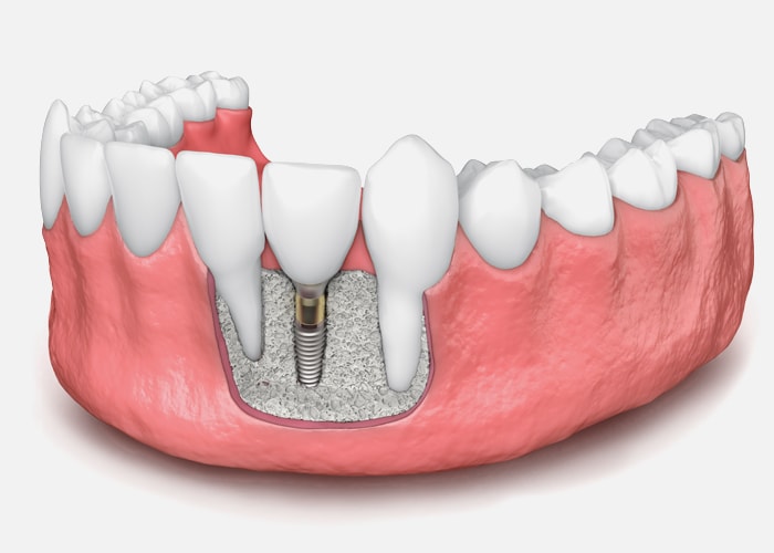 Illustration of an implant placed in grafted bone in the lower jaw