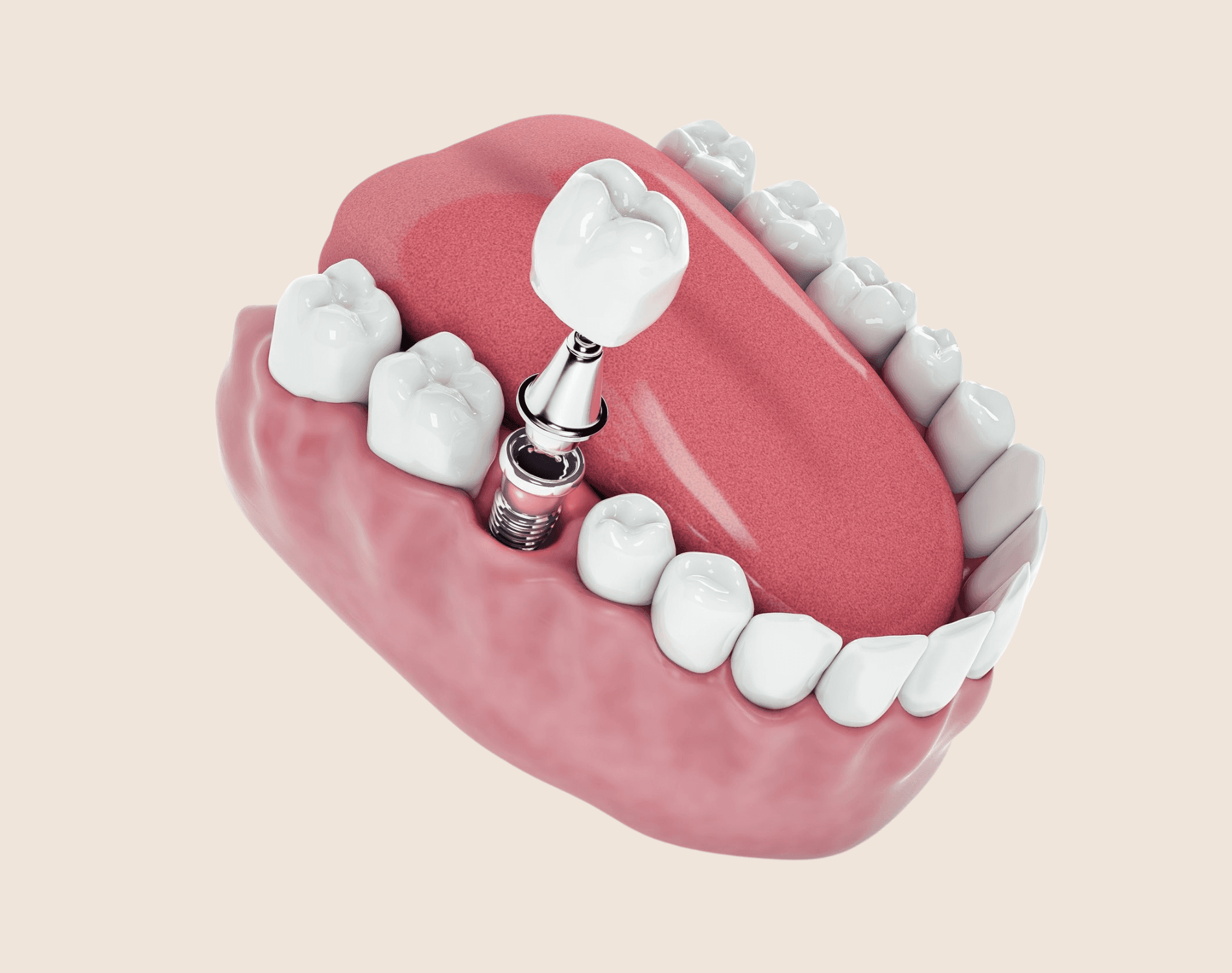 Illustration of a dental implant with a crown in the lower jaw