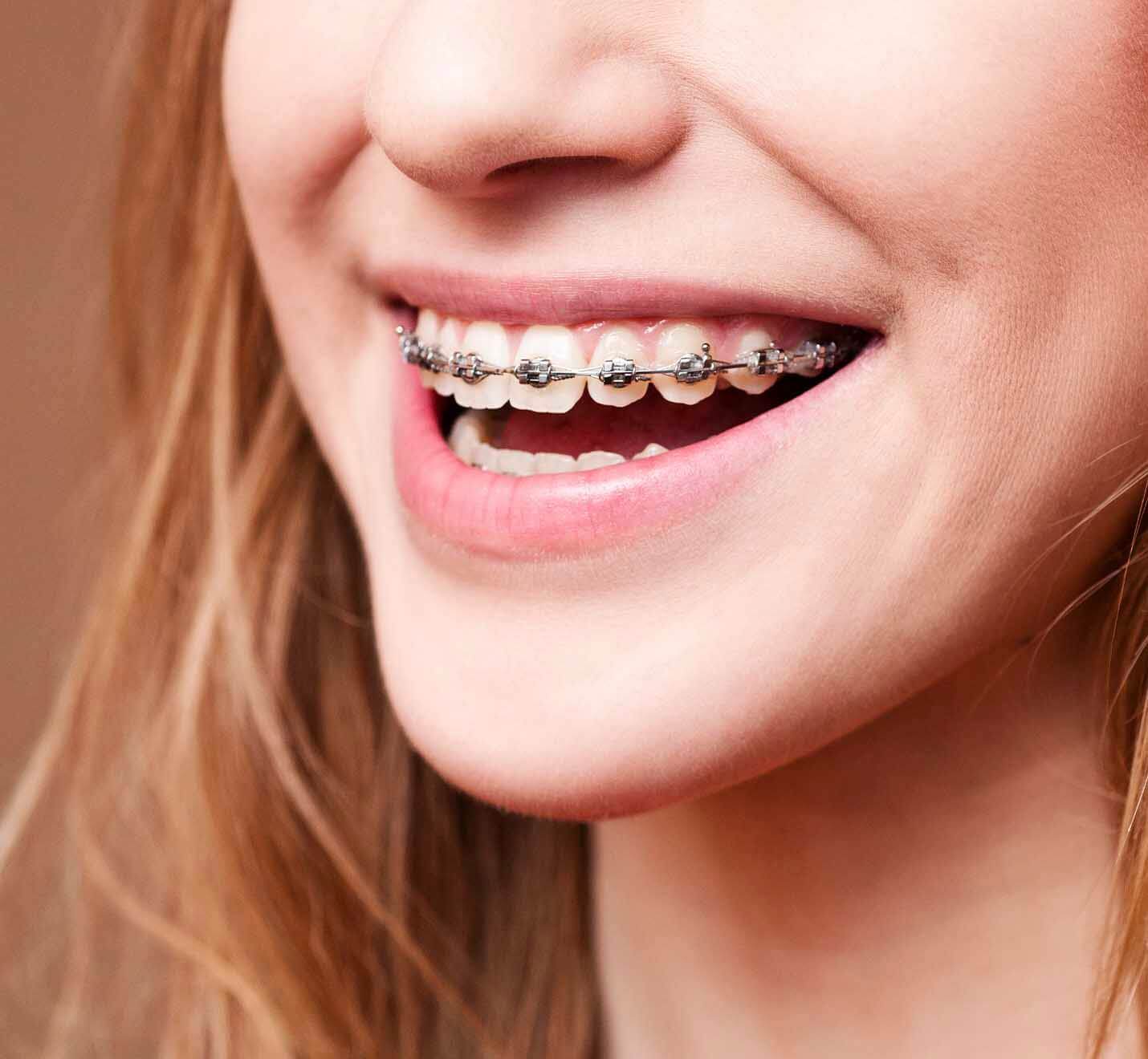 Close-up of a smile with metal braces