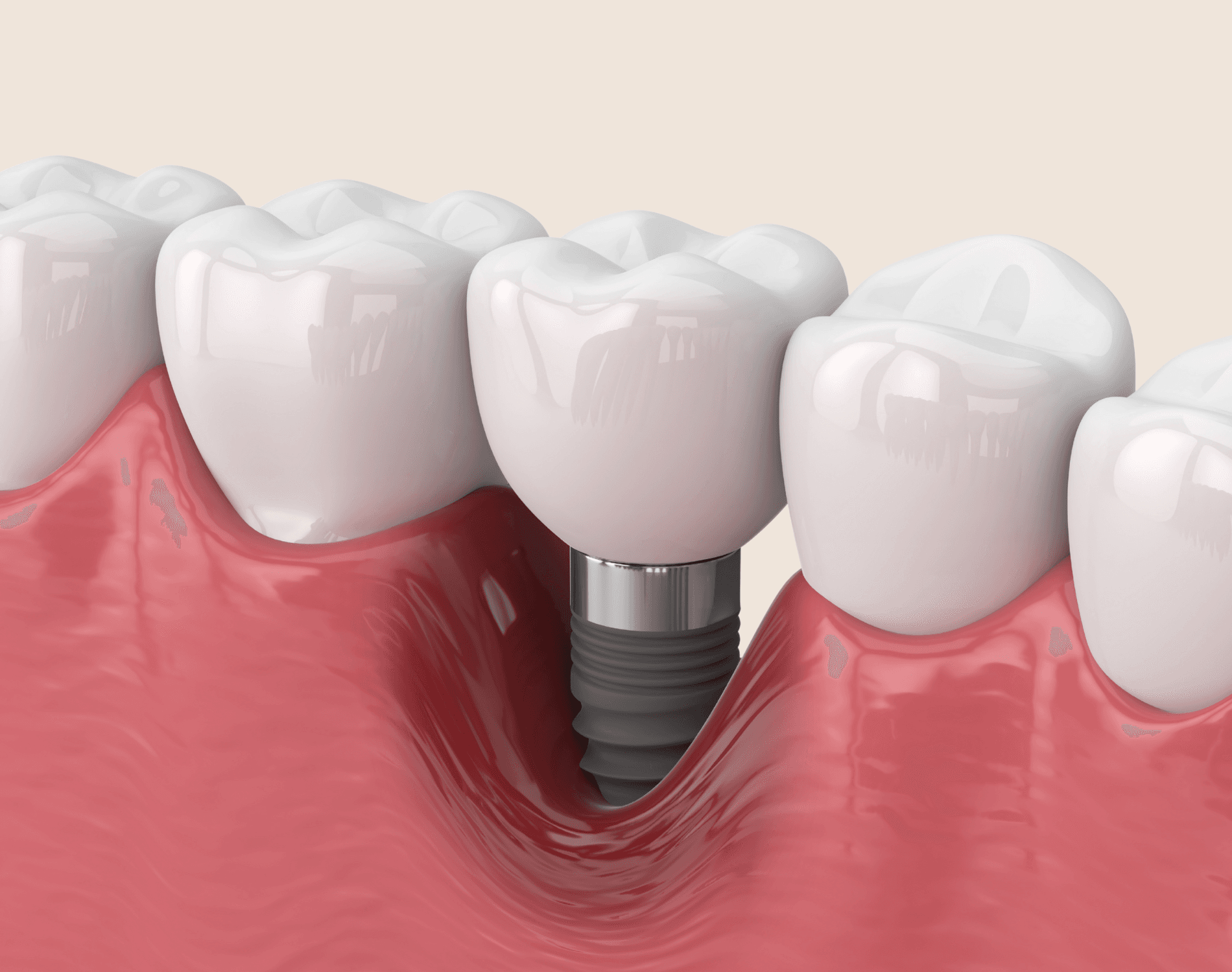 Illustration of a dental implant placed between natural teeth