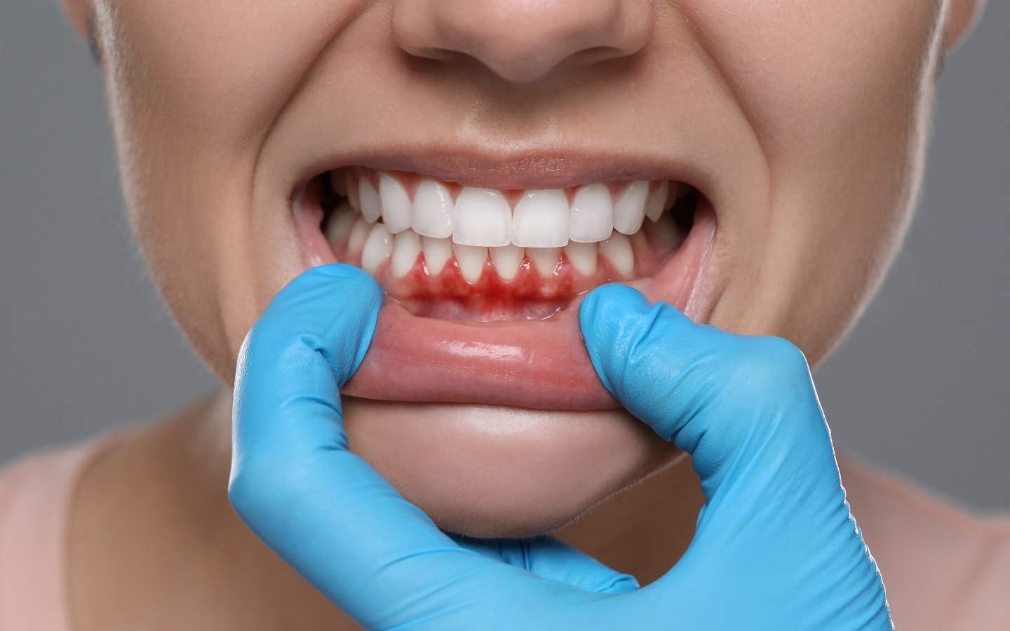 Gloved hand lowering a lip to show inflamed, bleeding gums
