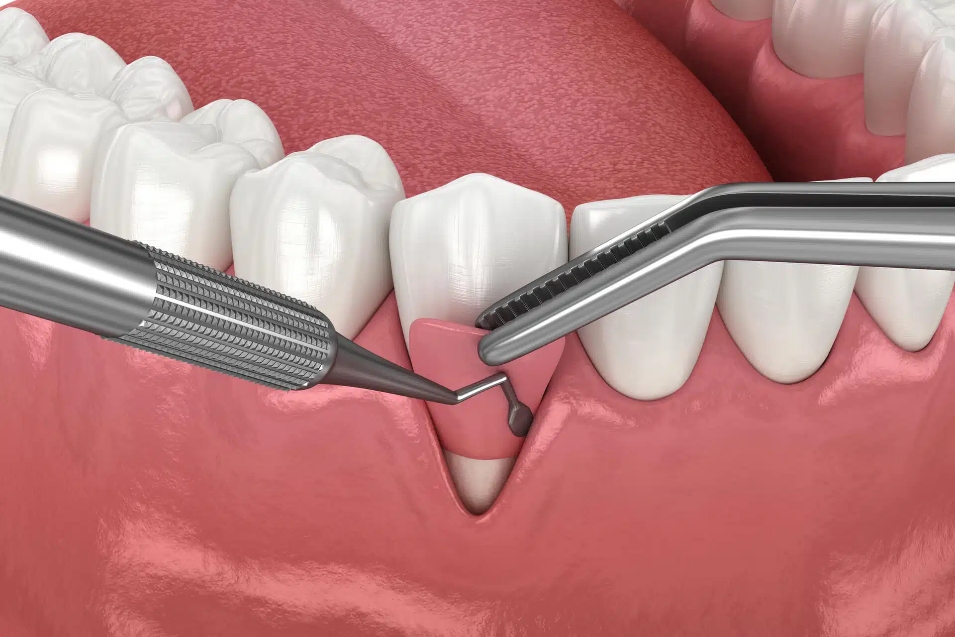Illustration of gum graft surgery on the lower teeth