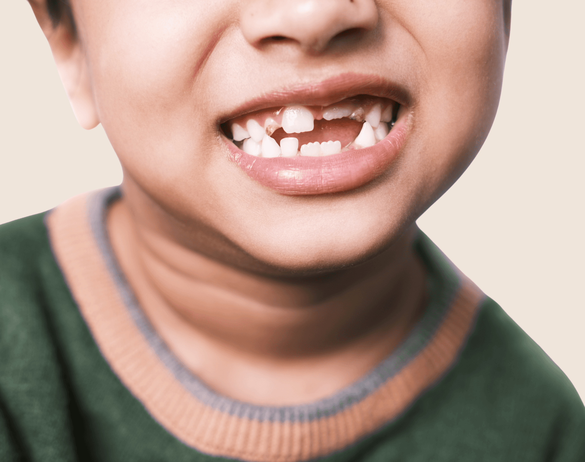 Child smiling with a missing front tooth