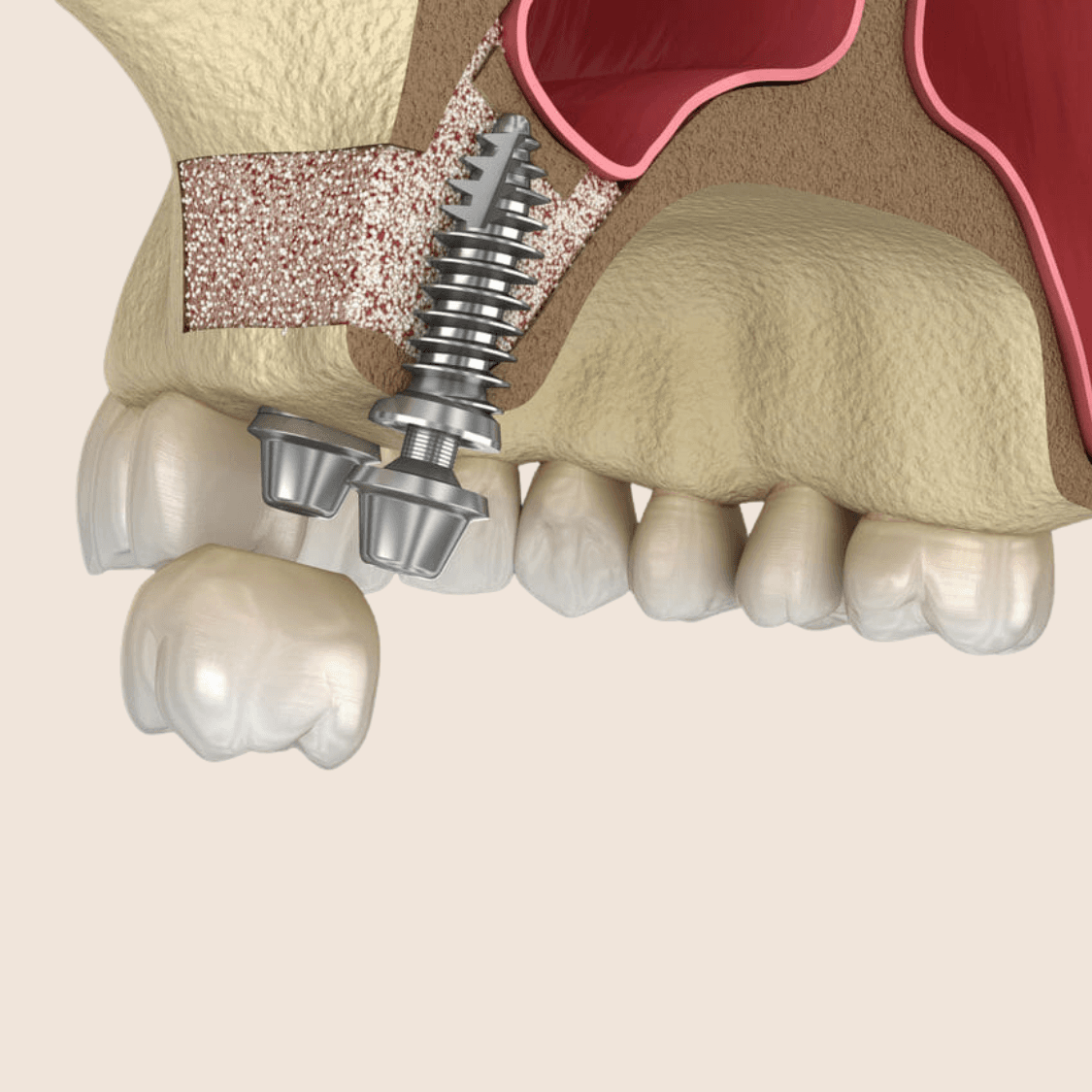 Illustration of a sinus lift with a bone graft and implant in the upper jaw