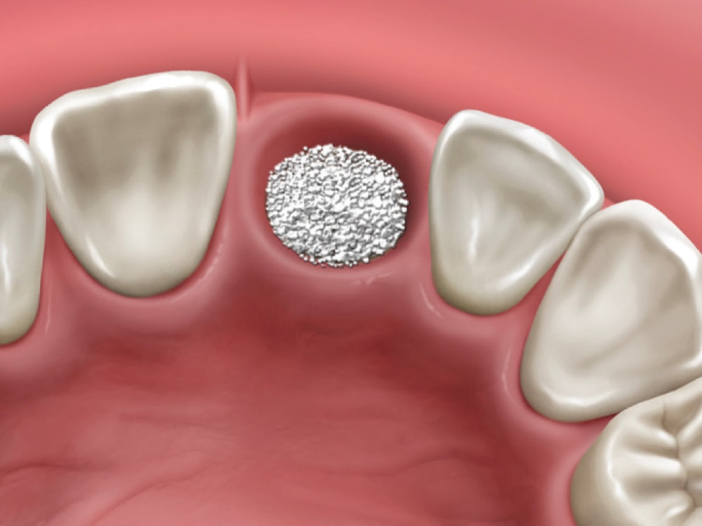 Illustration of a bone graft filling an empty tooth socket